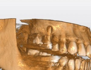 rct treatment 根管治療1CT拡大